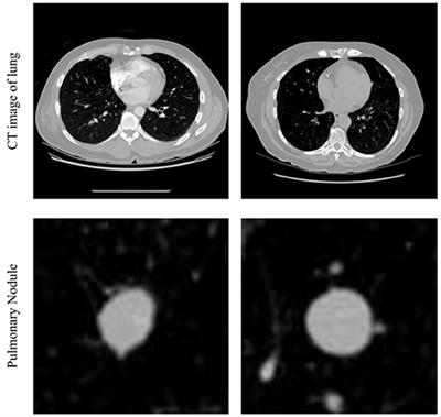 Reducing False-Positives in Lung Nodules Detection Using Balanced Datasets